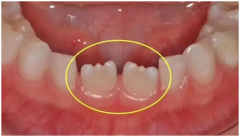儿童门牙有锯齿状，是不是有问题？